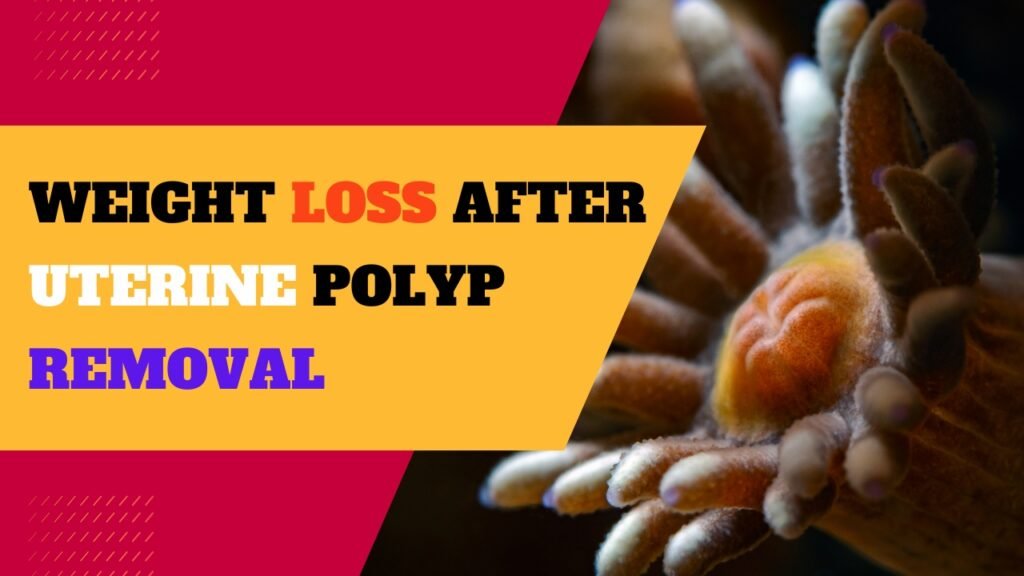 The Road to Weight Loss After Uterine Polyp Removal